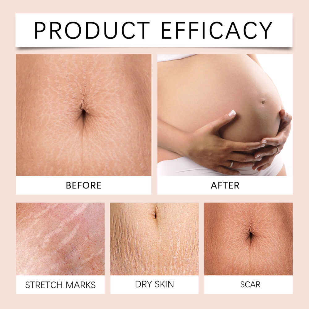 Pregnancy scar repair cream - Image 5