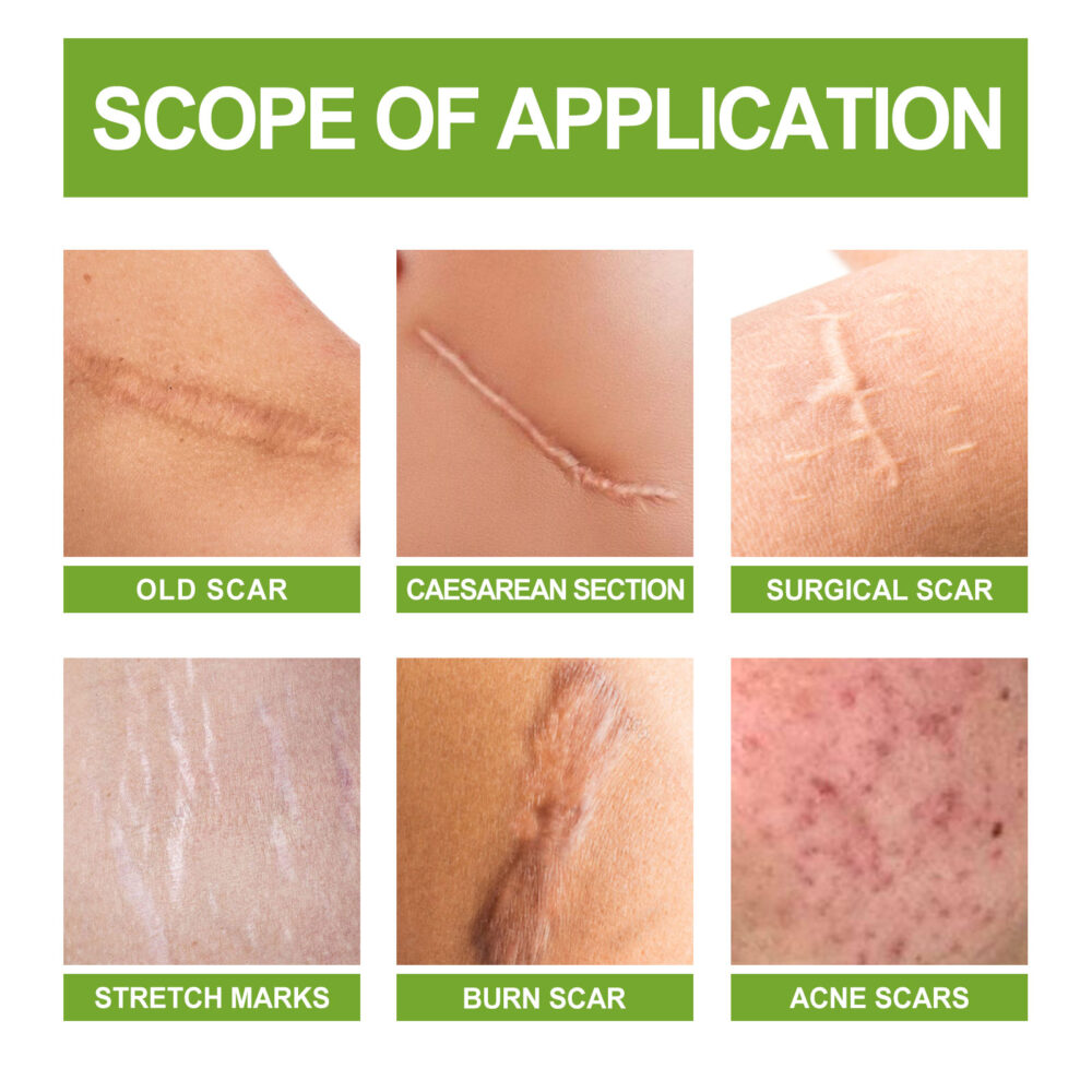 Salicylic acid scar removing gel - Image 6