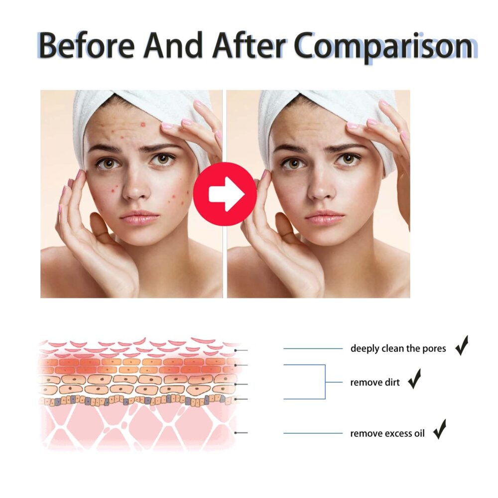 Salicylic Acid Acne Removing essence - Image 3