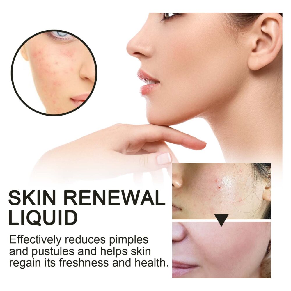 Salicylic Acid Acne Removing essence - Image 4