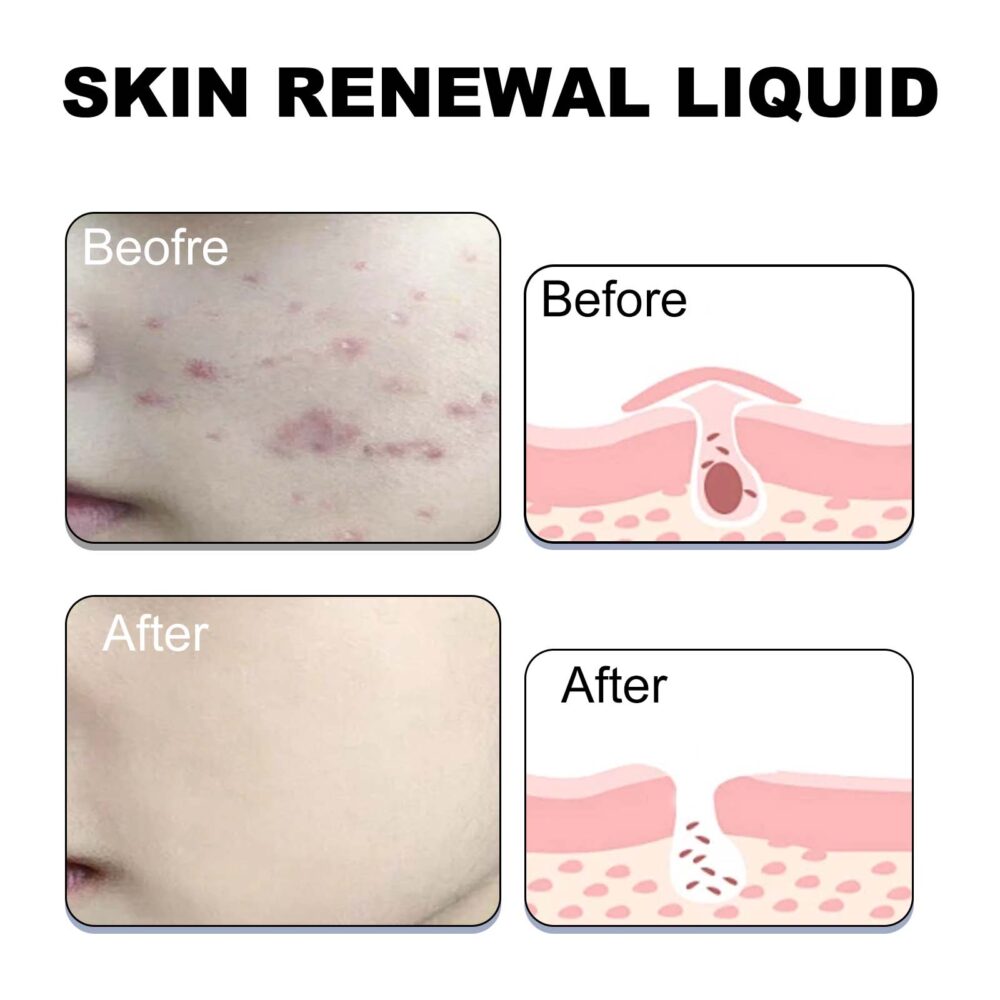 Salicylic Acid Acne Removing essence - Image 5