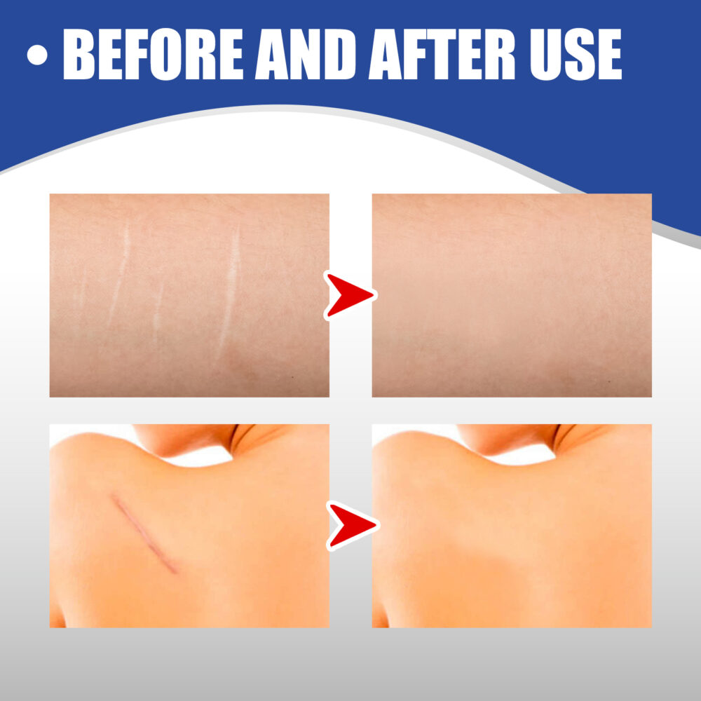 Scar removal silicone tape - Image 5
