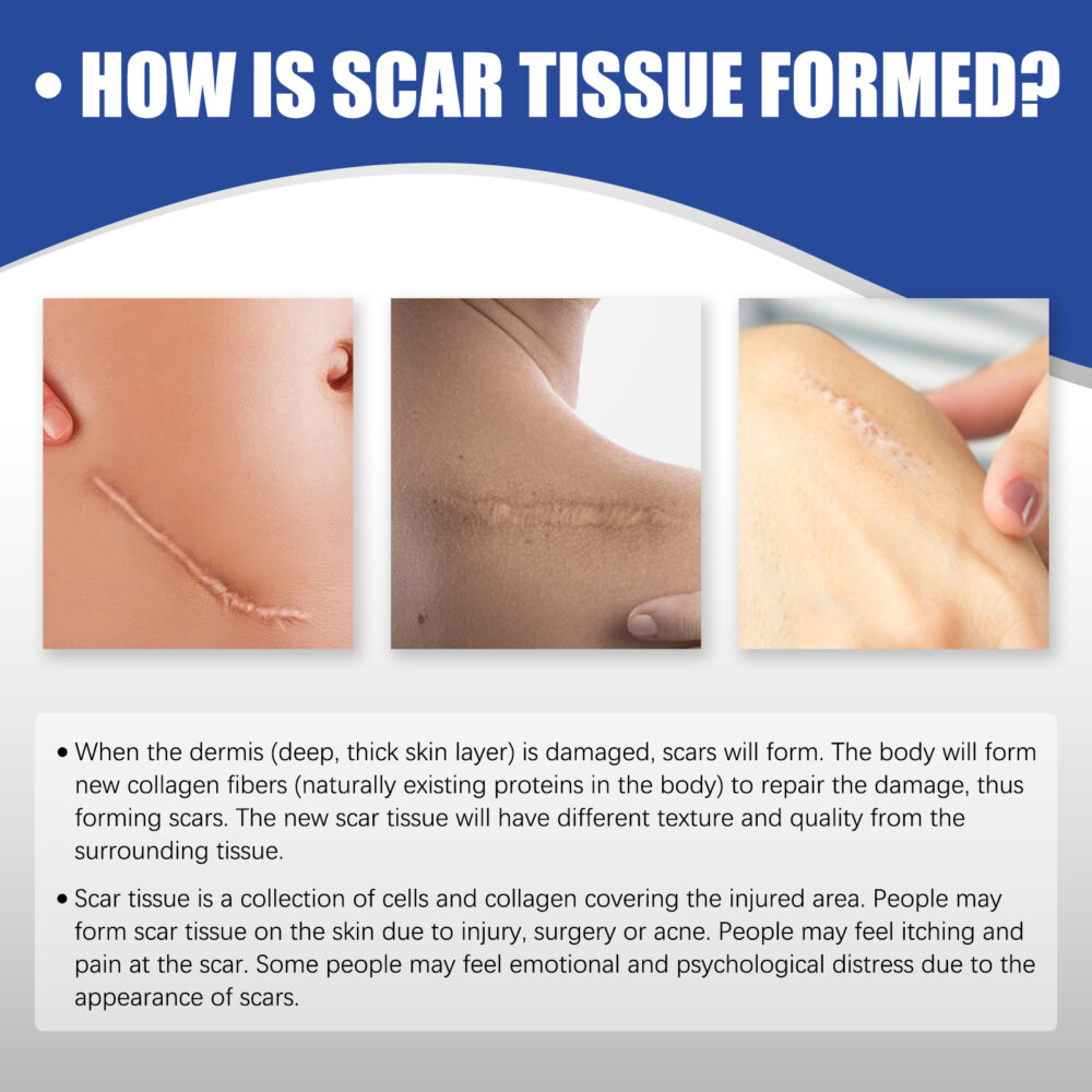 Scar removal silicone tape - Image 7