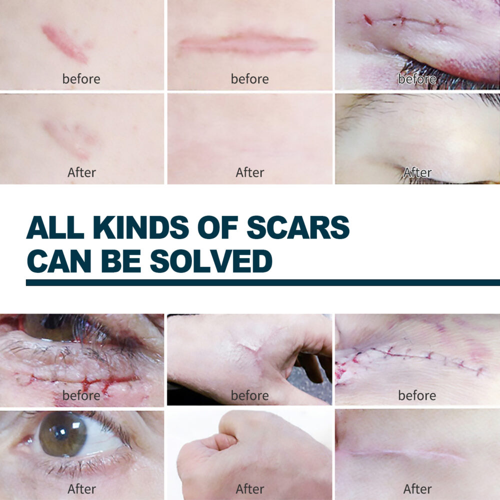 Silicone scar repair patch - Image 6