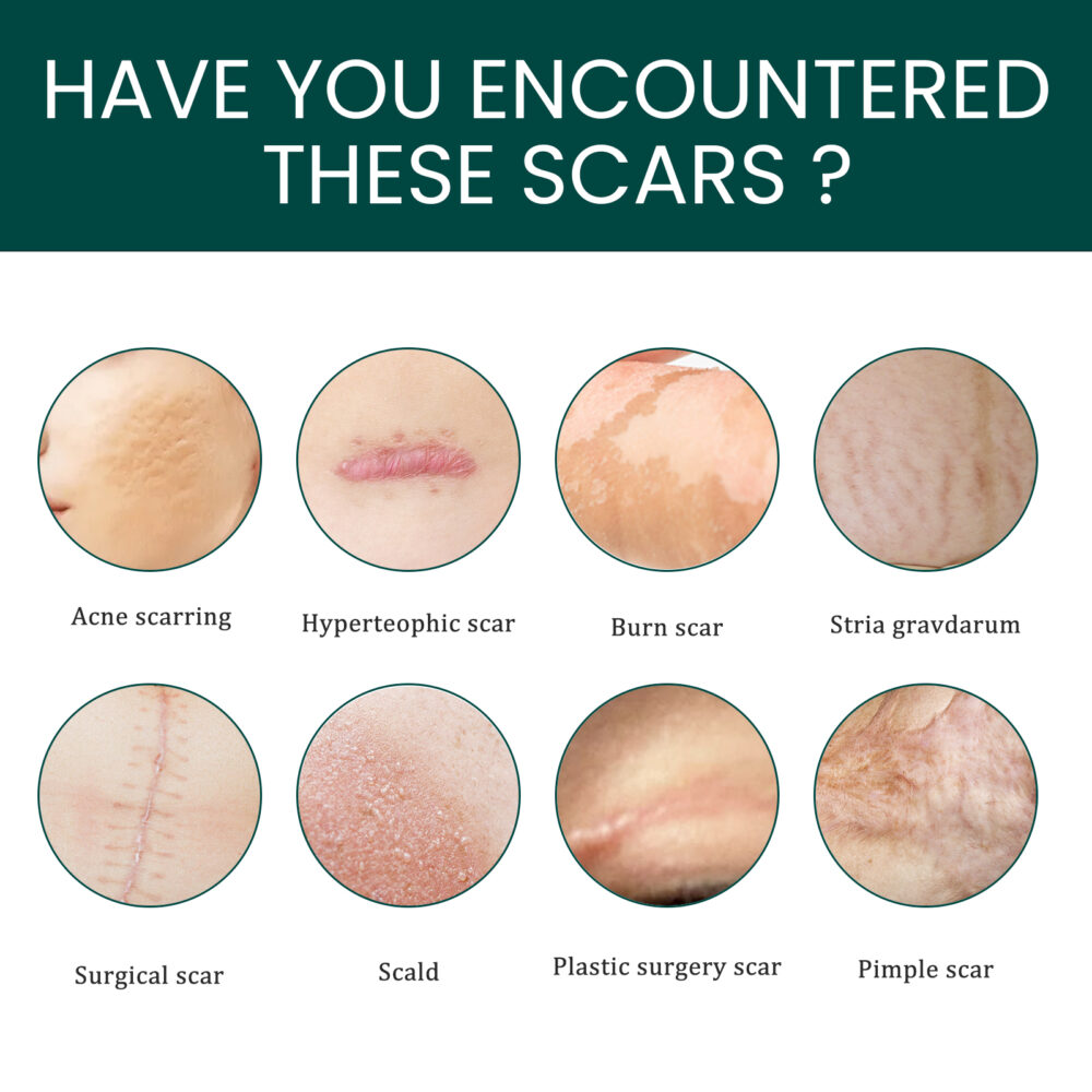 Silicone scar repair patch - Image 3