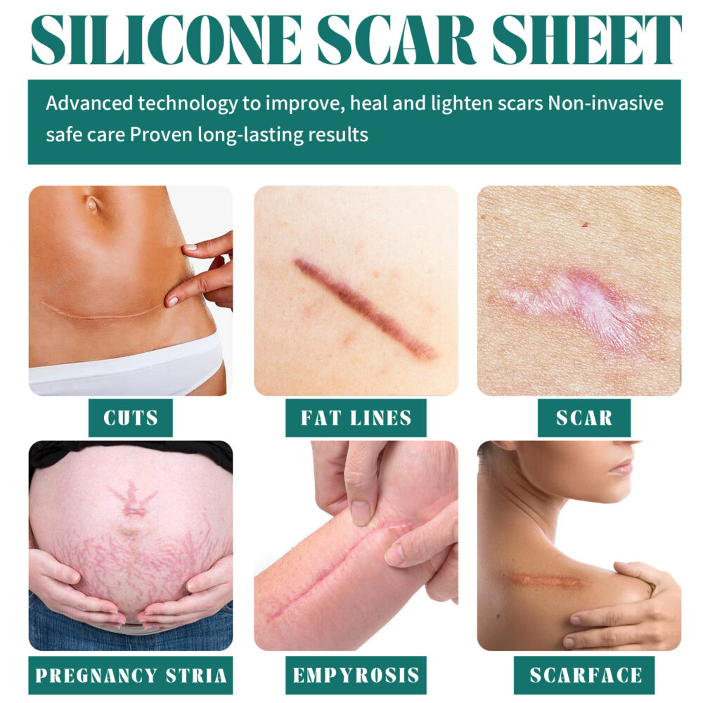 Silicone scar removal patch - Image 7