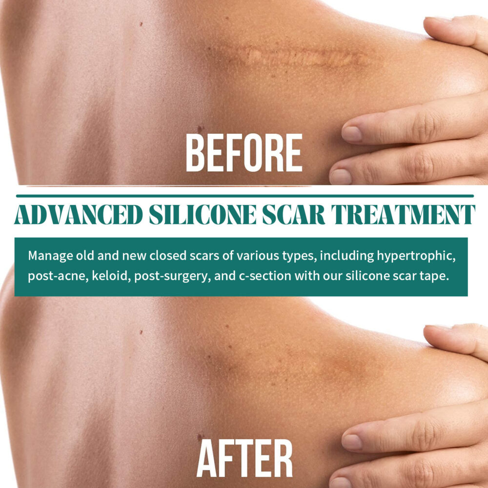 Silicone scar removal patch - Image 6