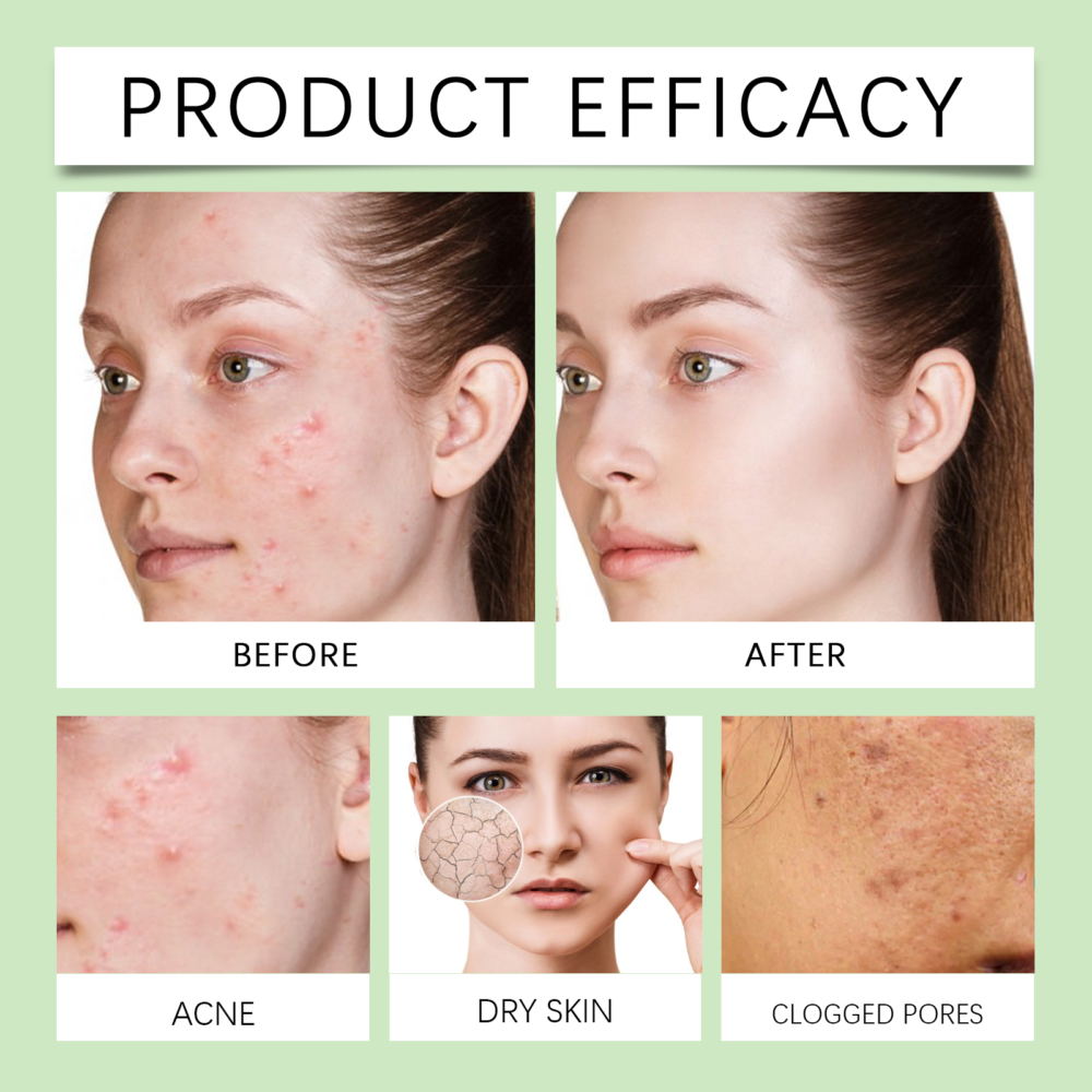 Mint Acne Cream - Image 4